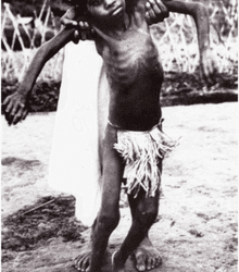 Penyakit Kuru yang menyerang anak anak Suku Fore – Jubi/Wikipedia.org