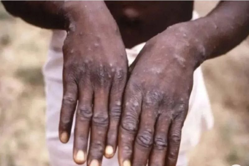 mpox